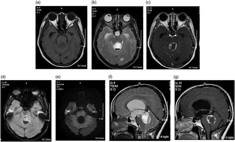 Fourth Ventricle Mri