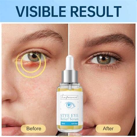 Stye Eye Treatment Chalazion Remover Eye Serum For Styes Chalazion And Blep Ebay