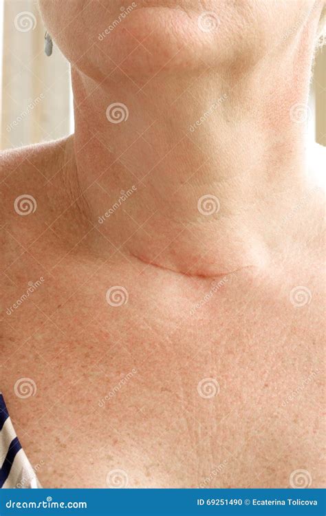 Neck Scar After Thyroidectomy Closeup Stock Photo Image Of Parts