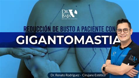 Reducción de busto a paciente con GIGANTOMASTIA YouTube