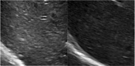 Ultrasound of the liver showing coarse echotexture before dietary... | Download Scientific Diagram