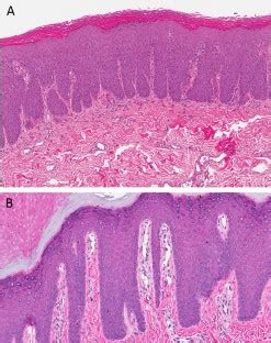 Common And Critical Inflammatory Dermatoses Every Pathologist Should