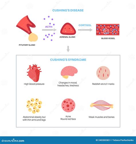 Cushing Syndrome Symptoms Illustration Of The Common Features Of The