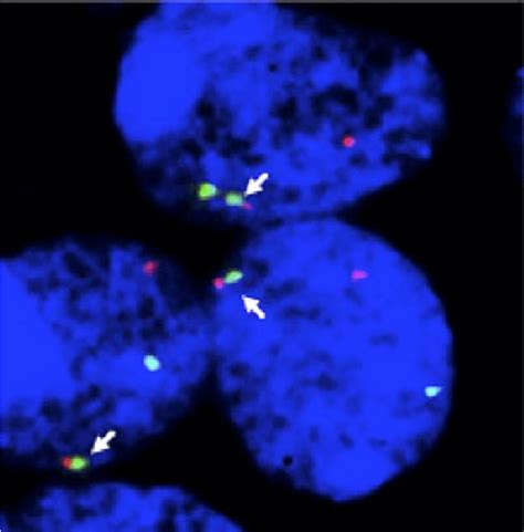 Interphase Dual Colour FISH Analysis By Co Hybridization Of The