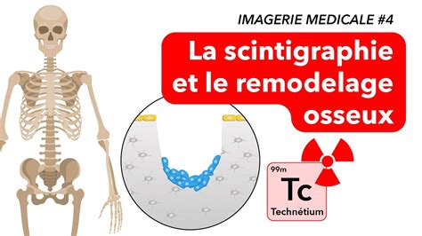 Imagerie Medicale La Scintigraphie Et Le Remodelage Osseux Youtube