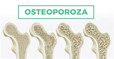 Osteoporoza Przyczyny Objawy I Leczenie Zdrowe Plecy