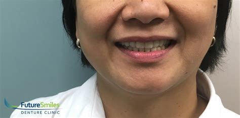 Calgary Denture Clinic Patient Success Story Denture Repair