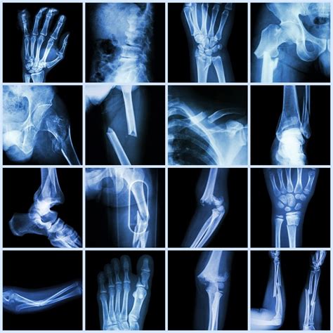 What Are Bone Fractures Learn All About The Condition