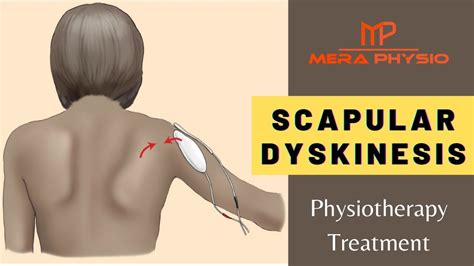 Scapular Dyskinesis Physiotherapy Treatment In Hindi Mera Physio