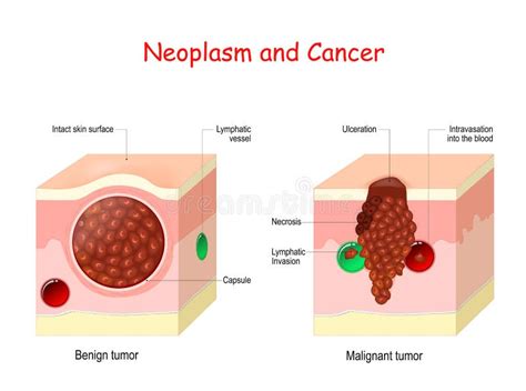 Malignant Neoplasm: What It Is, Types Factors, 55% OFF