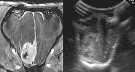 Frontiers Intraoperative Ultrasound Applications In Intracranial Surgery