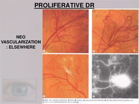 Diabetic retinopathy