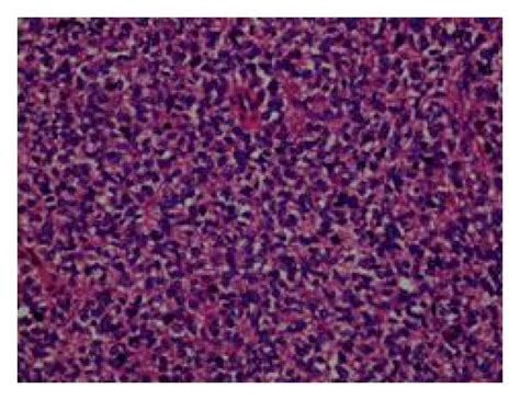 A Photomicrograph Showing Sheets Of Proliferating Round Cells