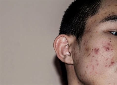 Close up of acne on the skin, Acne on the face caused by Hormone ...