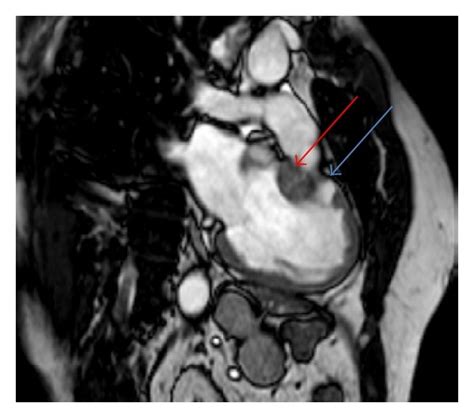 Cardiac Magnetic Resonance 2 Chamber Cine View Imaging Of The Patient