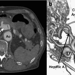 a, Computed tomography (CT) scan shows the aneurysm of the celiac ...