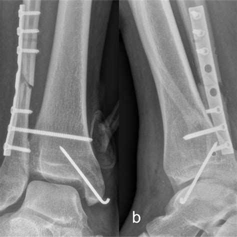 Anteroposterior A And Lateral B Radiographs After Lateral Fibular Download Scientific