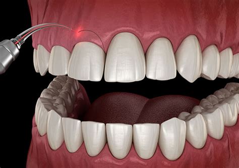 Laser Gum Treatment Dr Paul S Dental Clinic In Dubai