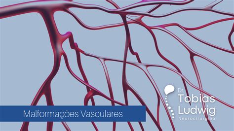 Malforma Es Vasculares Dr Tobias Ludwig