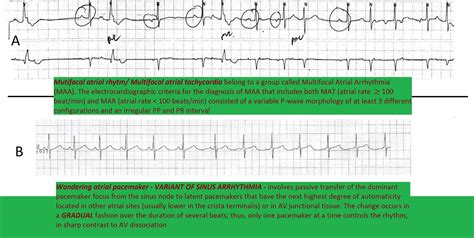 Wandering Atrial Pacemaker Ecg