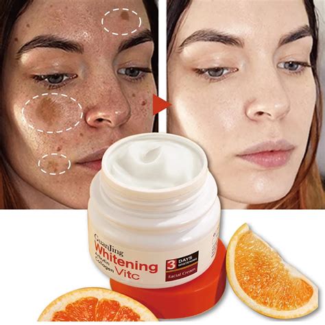 Whitening Freckle Cream Remove Melasma Dark Spot Lightening Melanin