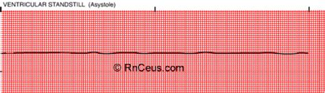 Ventricular Dysrhythmias Flashcards Quizlet