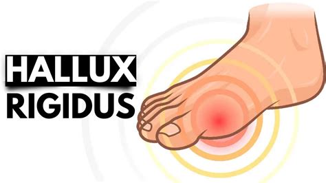 Hallux Rigidus The Stiff Big Toe Condition And Treatment Options Youtube