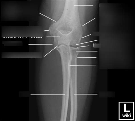 Elbow Ap Xray Diagram Quizlet