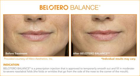 Dermal Fillers Belotero Balance Avri Laser Aesthetics