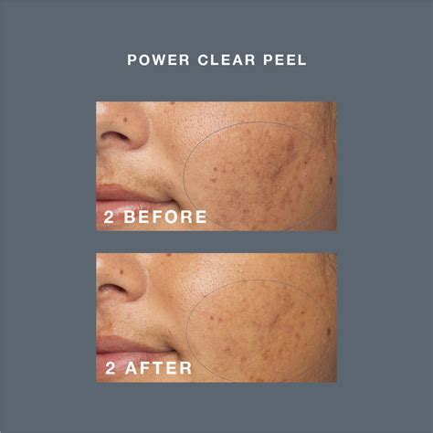 Pro Power Peel 30 | Elixir Beauty