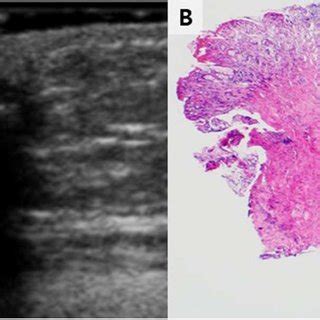 An umbilical polyp in an 11-month-old girl A. Transverse... | Download ...