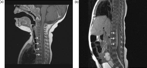 Mri Of The Neonatal And Paediatric Spine And Spinal Canal European