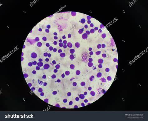 Acute Lymphoblastic Leukemia Blood Smear Stock Photo 2175197925 ...