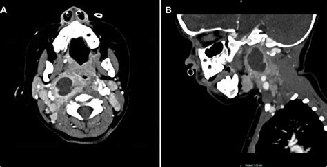 A Axial Contrast Enhanced Ct Scan Of A 2 Year Old Patient Showing A Download Scientific Diagram