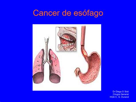 Cáncer De Esófago