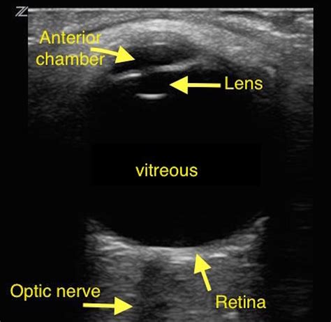 Ocular Ultrasound Made Easy Step By Step Guide POCUS 101 41 OFF