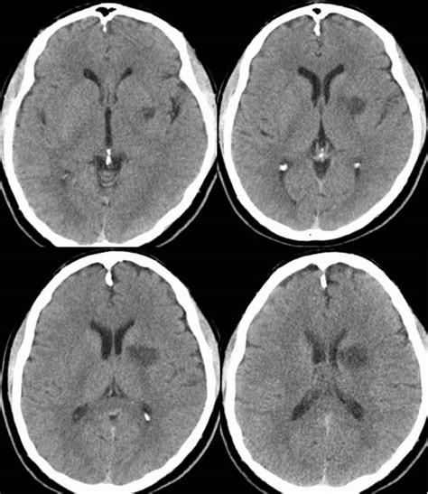 Subacute Infarct