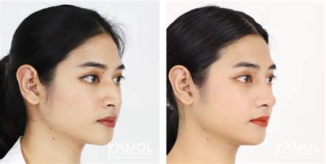 Rhinoplasty Nose Job Revision Rhinoplasty