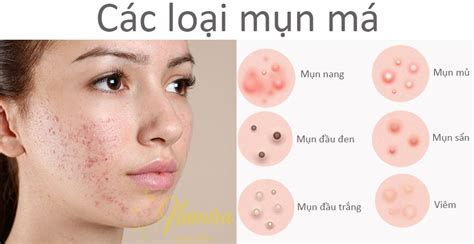 Mụn ở Má Nguyên Nhân Và Cách Trị Mụn Má LÀm ĐẸp Spa