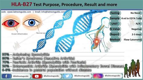 Reactive Arthritis Hla Test Purpose Procedure Results And Many More Ltg