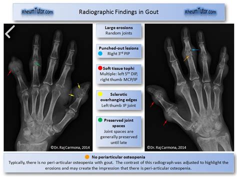 Gout Hand Radiograph · Rheumtutor