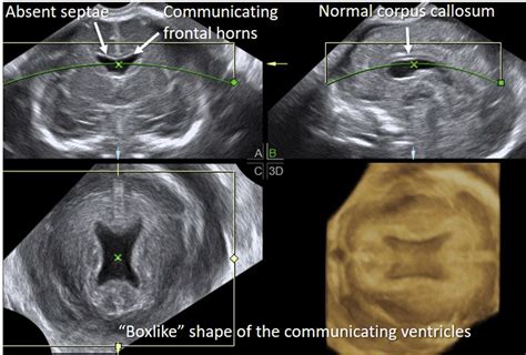 Absent Cavum Septi Pellucidi American Journal Of Obstetrics And Gynecology