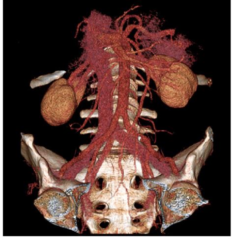 The Preoperative Ct Angiography Of The Prevertebral Arteries And Veins