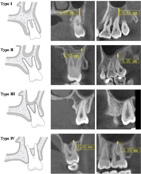 Relationship Between Maxillary Posterior Molar Roots And The Maxillary