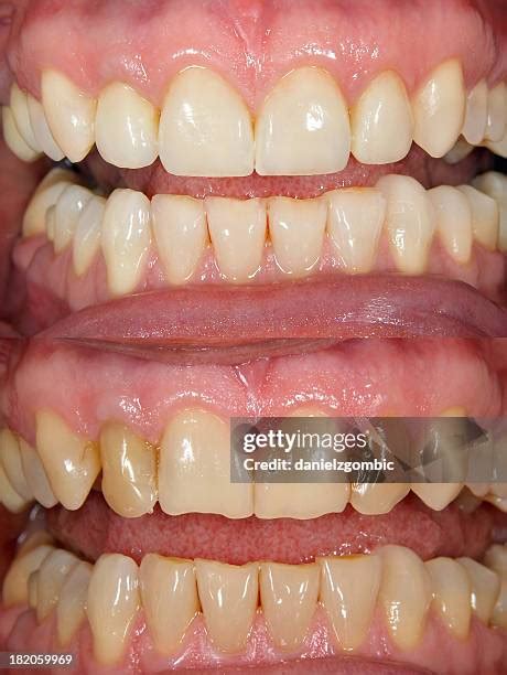 155 Ugly Teeth Smile Stock Photos High Res Pictures And Images