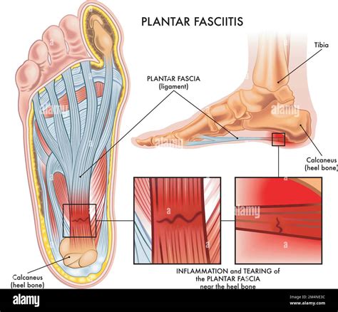 Illustration M Dicale Montrant Une Section Du Pied Pr Sentant Des