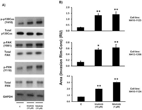 Imatinib And Nilotinib Treatment Of Stem Cells From Human Gbm Biopsies