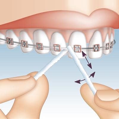 Flossf Den Vom Bandmirafloss Implant Hager Werken Gmbh Co Kg