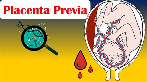 Placenta Previa Causes Risk Factors Signs Symptoms Diagnosis