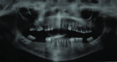 Orthopantomograph Showing Radiolucent Changes In The Mandible